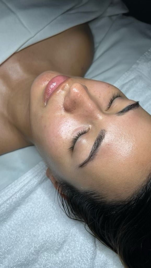 MICRONEEDLING ™ - Durée 45MIN